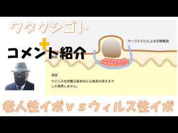 「ウィルス性イボ、切除しましょう」ｂｙ形成外科クリニック←私事【アラ還・読書中毒】コメ：インフルエンザワクチン打ちますか？と聞かれましたが!認知症が増えたのはワクチンに入ってるチメロサール水銀とアルミ
