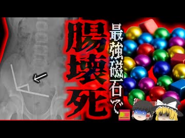 　『超強力磁石で緊急手術』中学生がネットで『ネオジム磁石』を購入　約200個飲み込んだ結果、腸壁が挟まれ壊死…緊急開腹手術へ【ゆっくり解説】