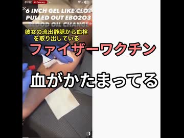 ファイザーワクチンで94%血栓できる　びょーんと紐みたいに固まった血