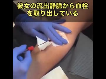 ファイザーのワクチンを打った□が見ての通り塊に‼️怖い