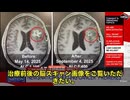 いま世界の医療界で衝撃が走っています。 公開されたのは、脳腫瘍が“数ヶ月で溶けていく”前後比較のスキャン画像。 提示したのは、アブラキサンの開発者として知られる外科医パトリック・スン＝ション氏です