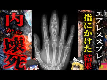 【2002】『傷が小さいし大したことないだろう』→塗装装置で指先を負傷した作業員 直径1mm未満の極小の傷を放置した結果、指が3倍に腫れ内部が壊死…手術を繰り返したが切除…【ゆっくり解説】