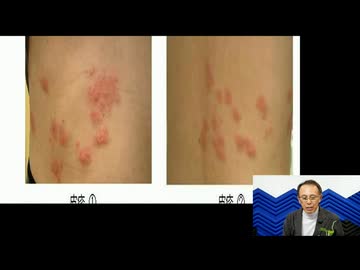 2025.02.10放送  帯状疱疹ワクチン、定期接種化への大疑問！ ★今夜は長尾和宏独演会です★前半無料部分