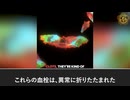 COVID-19ワクチン接種者の100％にプリオン様アミロイド微小血栓　巨大白色線維性血栓へと蓄積