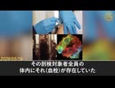 COVID-19ワクチン接種者の100％にプリオン様アミロイド微小血栓　巨大白色線維性血栓へと蓄積
