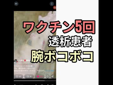 ワクチン5回接種透析患者がシャントで腕ボコボコ　なぜか選択肢を間違える　聞く耳持たない